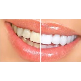 Estrazione dentale + pulizia dei denti con smacchiamento Air-Flow